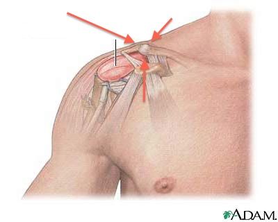 inflammation i axeln inflammation i axeln